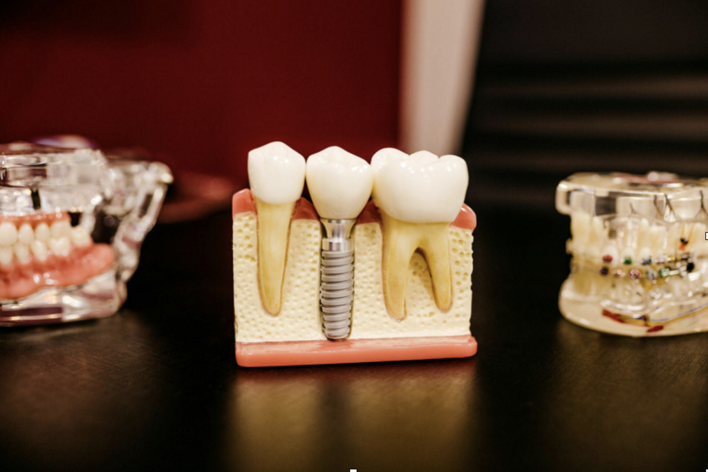 Example of dental implants on teeth